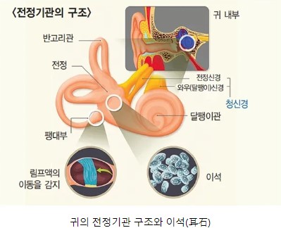 이석증 증상과 원인, 자가치료 방법